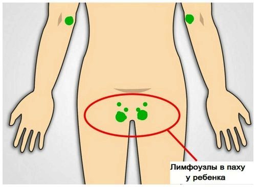 лімфовузли дитина запалення лікування причини пах