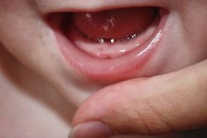 Чи може бути пронос при прорізуванні зубів: скільки тримається і як лікувати пронос при прорізуванні зубів ніж лікувати