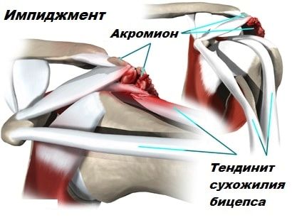 як лікувати розтягнення біцепса