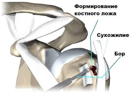 тендиніт головки біцепса сухожилля плече лікування