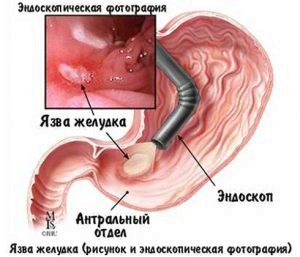 Болить шлунок у дитини: лікування, що робити, дієта як лікувати шлунок у дітей