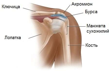 як лікувати бурсит плечового суглоба