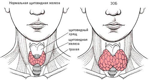 як лікувати змішаний зоб