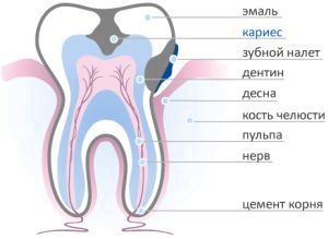 Глибокий карієс - причини, симптоми, лікування, профілактика, ускладнення глибокий карієс лікування
