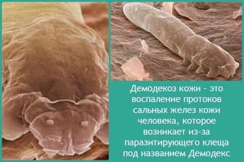 Як лікувати демодекоз у дітей: які здавати аналізи, поради фахівця... як лікувати демодекоз у дітей