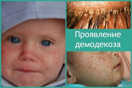 Як лікувати демодекоз у дітей: які здавати аналізи, поради фахівця... як лікувати демодекоз у дітей