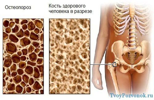 як лікувати остеопороз кісток