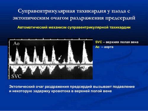 як лікувати тахікардію плода