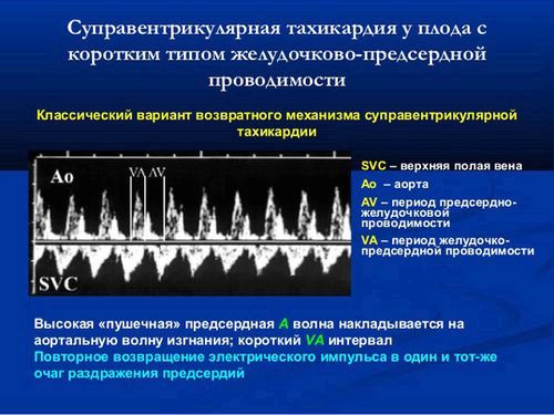 як лікувати тахікардію плода