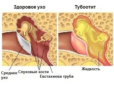 як лікувати хронічний тубоотит