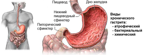 Хронічний гастрит: що це таке? Лікування, симптоми хронічний гастрит атрофічний лікування харчування при загостренні у дітей неатрофіческій симптоми що таке ознаки як вилікувати профілактика класифікація гиперпластический причини ускладнення діагностика патогенез гіперацидний аутоімунний реабілітація при хронічному лимфоидного формуванням клініка активний схема дорослих робити беруть код назавжди гипертрофический МКБ дифузний субатрофический змішаний армія катаральний меню антрум дуоденіт підвищеною кислотністю шлунка типу 10 тобто можна