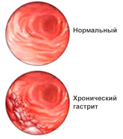 Хронічний гастрит: що це таке? Лікування, симптоми хронічний гастрит атрофічний лікування харчування при загостренні у дітей неатрофіческій симптоми що таке ознаки як вилікувати профілактика класифікація гиперпластический причини ускладнення діагностика патогенез гіперацидний аутоімунний реабілітація при хронічному лимфоидного формуванням клініка активний схема дорослих робити беруть код назавжди гипертрофический МКБ дифузний субатрофический змішаний армія катаральний меню антрум дуоденіт підвищеною кислотністю шлунка типу 10 тобто можна