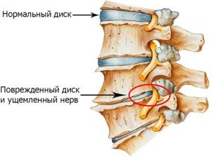 як лікувати нерви спини