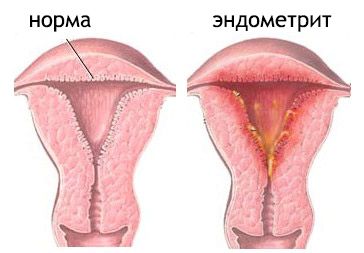 Виділення в жінок: білі, коричневі, жовті (менструальний цикл) менструальний цикл