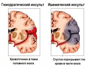 Лечение след инсулт с народни средства