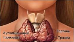 tiroidiene autoimune tiroidita ce este
