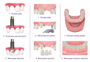 Proteza sau implantare