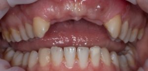 Proteza sau implantare Proteza sau implantare