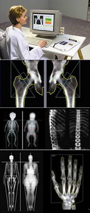 Ce este osteoporoza osoasă