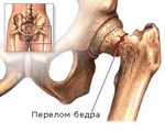 Ce este osteoporoza osoasă