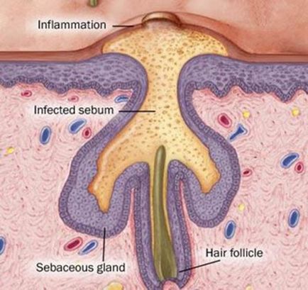 Acnee, care este în ele