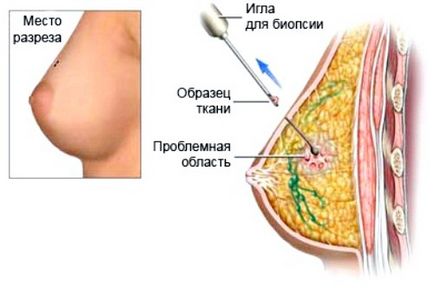 Analiza biopsii pentru care Analiza biopsii pentru care