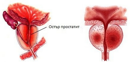 Prostatita care a tratat Prostatita care a tratat