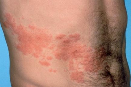 Cum se poate vindeca herpesul