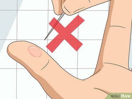 Ce să faci când obzhog cu degetul