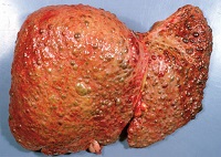 Hepatita cum să facă Hepatita cum să facă