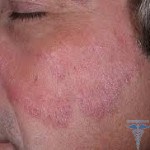 Care trateaza dermatolog