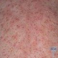 Care trateaza dermatolog