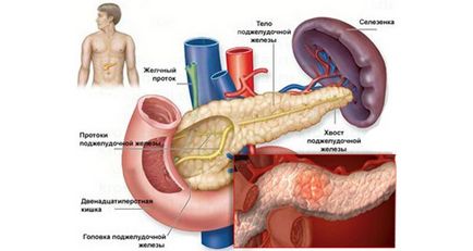 tratament pancreatită la domiciliu