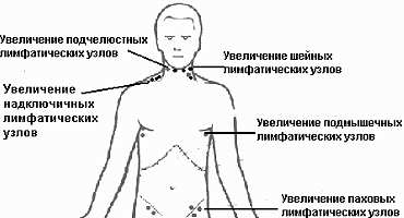 Umflate ganglionilor limfatici îndepărtat