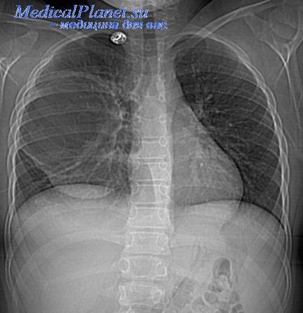 infecții pulmonare