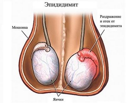 testicul Umflarea că