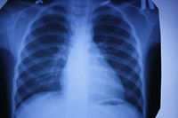 Forma închisă a tuberculozei, care este