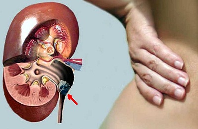 Rinichi pelvis ce este Rinichi pelvis ce este