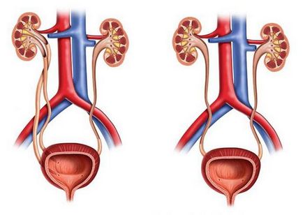 pelvis renal adulti extins-