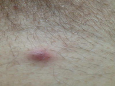 păr pubian pustulă, care este păr pubian pustulă, care este
