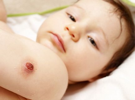 Vaccinarea BCG este că acesta este Vaccinarea BCG este că acesta este