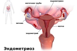 Uzi endometrioza