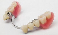 Proteza sau implantare Proteza sau implantare