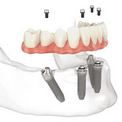Proteza sau implantare Proteza sau implantare