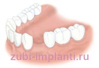 Proteza sau implantare Proteza sau implantare