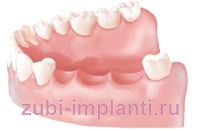 Proteza sau implantare Proteza sau implantare
