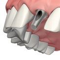 Proteza sau implantare Proteza sau implantare