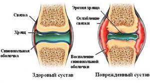 Cum de a restabili cartilajului