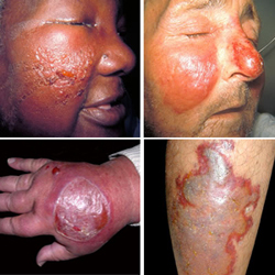 Ce este erizipel inflamație a pielii