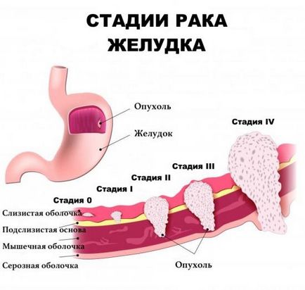 cancer in stadiu terminal